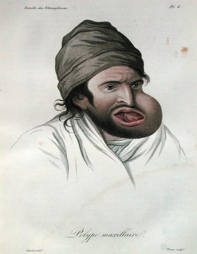 Polipo mascellare, da un libro di Baron Jean Louis Alibert da French School