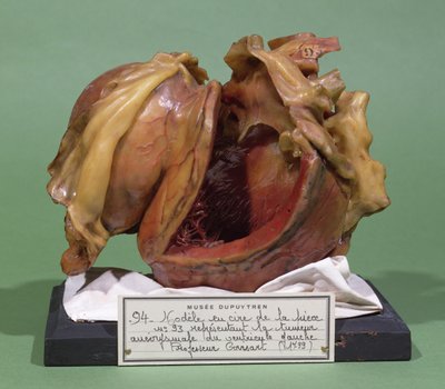 Modello di un tumore del ventricolo sinistro, 1799 da French School