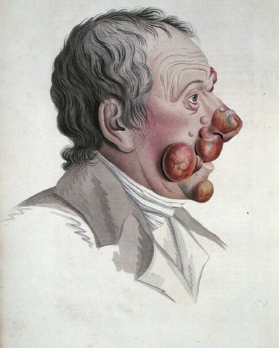 Micosi Fongoide, da un libro di Baron Jean Louis Alibert da French School