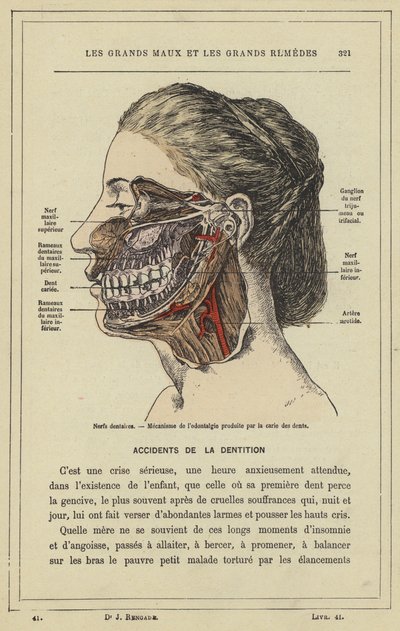 Nervi dentali, meccanismo del mal di denti causato dalla carie (litografia a colori) da French School