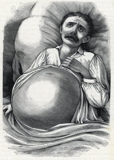 Paziente con cirrosi epatica avanzata (incisione) 1888 da French School