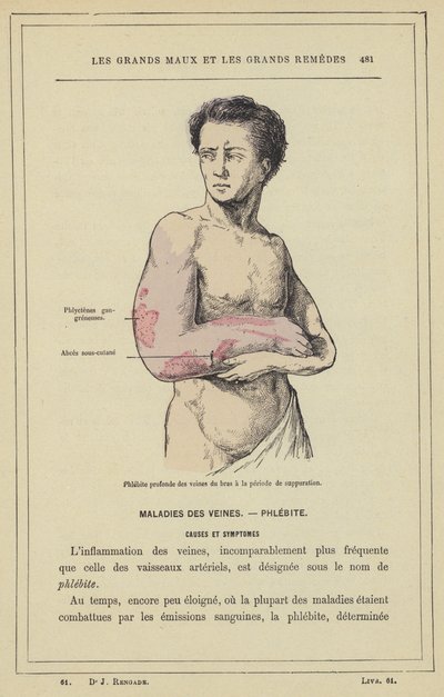 Flebite profonda delle vene del braccio nel periodo di suppurazione da French School