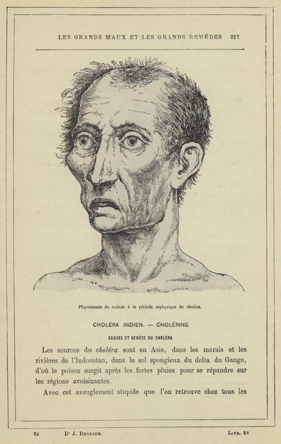 Fisionomia del malato nel periodo asfittico del colera da French School