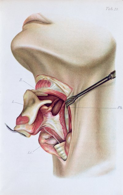 Tavola da Atlas and Epitome of Operative Surgery di Dr. Otto Zuckerkandl (1861-1921) 1910 da French School