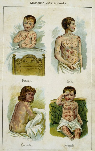 Tavola illustrativa delle malattie infantili: orticaria, scabbia, scarlattina e morbillo (estratto da Bilz, medicina naturale) fine XIX secolo da French School