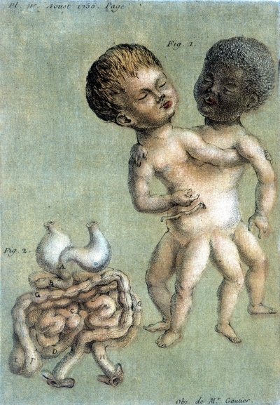 Tavola di medicina che rappresenta fratelli siamesi: uno bianco e uno nero. illustrazione di Toussaint (1756) in "Osservazioni periodiche sulla fisica, la storia naturale e le arti". da French School