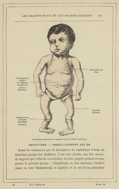 Principali deformazioni ossee in un bambino rachitico da French School