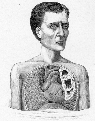 Rappresentazione di una persona con caverne, complicazione della tubercolosi (incisione) da French School