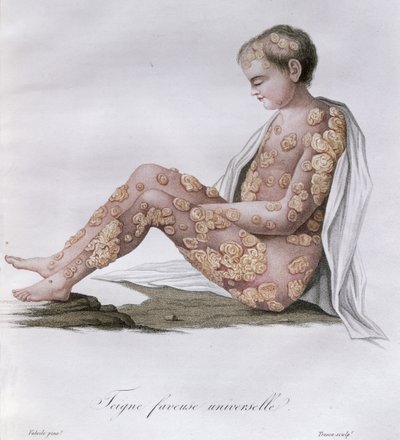 Tigna, da un libro di Baron Jean Louis Alibert (1768-1837) 1838 da French School