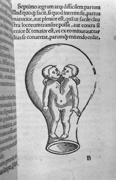 Bambini siamesi, illustrazione dal cosiddetto manoscritto Rhodion da French School