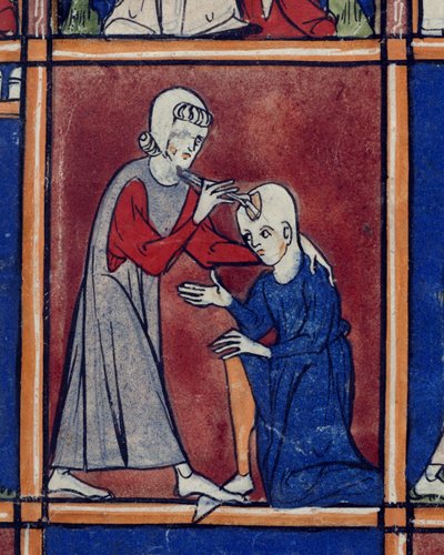 Operazione sul cranio di un paziente, illustrazione da 