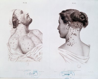 Sintomi della sifilide negli uomini e nelle donne, da un libro medico, c.1850-60 da French School