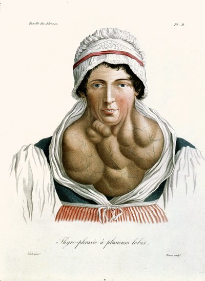 Malattia della tiroide, da un libro di Baron Jean Louis Alibert (1768-1837) 1817 da French School