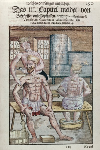 Coppettazione, da Ophthalmodouleia di Georg Bartisch (1535-1636) pubblicato a Dresda nel 1583 (stampa a blocchi di legno a colori) da German School
