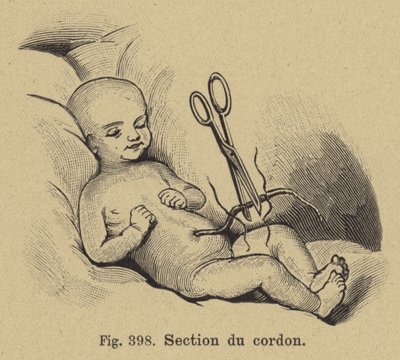 Taglio del cordone ombelicale di un neonato da German School