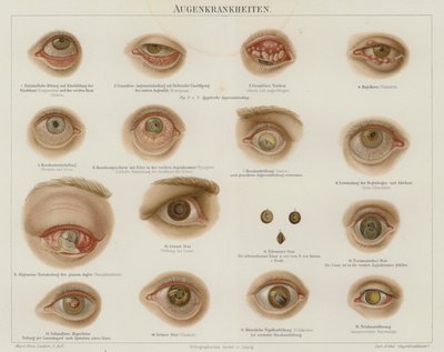 Disturbi oculari da German School