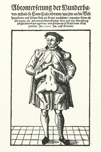 Hans Kaltenbrunn e il suo gemello congiunto non sviluppato da German School