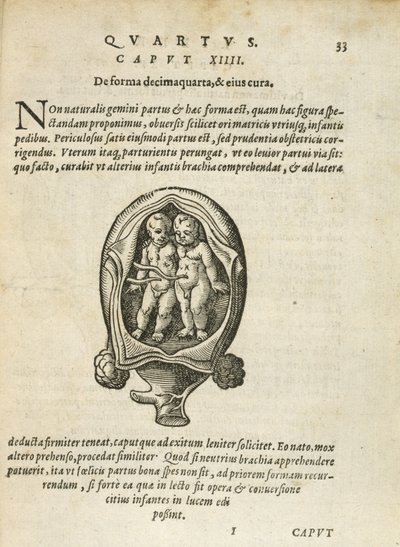 Gemelli non identici nel grembo materno, illustrazione dal capitolo 14, Libro 4 di Sulla concezione e crescita dell