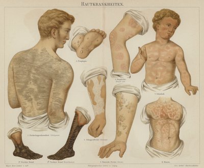 Disturbi della pelle da German School