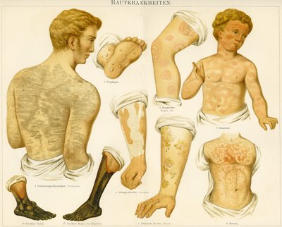 Disturbi della pelle, c.1890 da German School