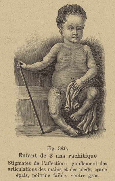 Bambino di tre anni affetto da rachitismo da German School