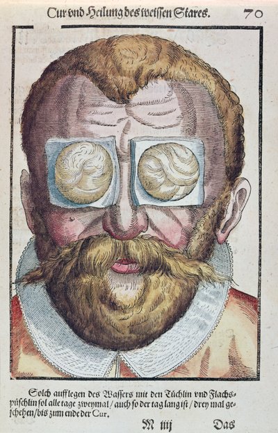 Trattamento di una condizione oculare, da Ophthalmodouleia di Georg Bartisch (1535-1636) pubblicato a Dresda nel 1583 da German School