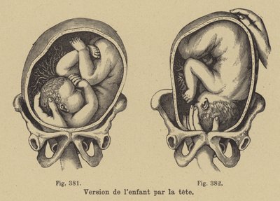 Girare un bambino nel grembo materno in modo che la testa sia rivolta verso il basso prima della nascita da German School