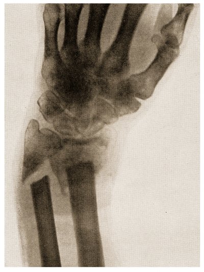 Radiografia di un polso fratturato c.1890 da German School
