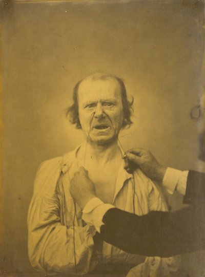 Scontento, cattivo umore da Guillaume Benjamin Amant Duchenne
