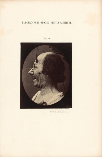 Elettrofisiologia fotografica, Figura 39 da Guillaume Benjamin Duchenne