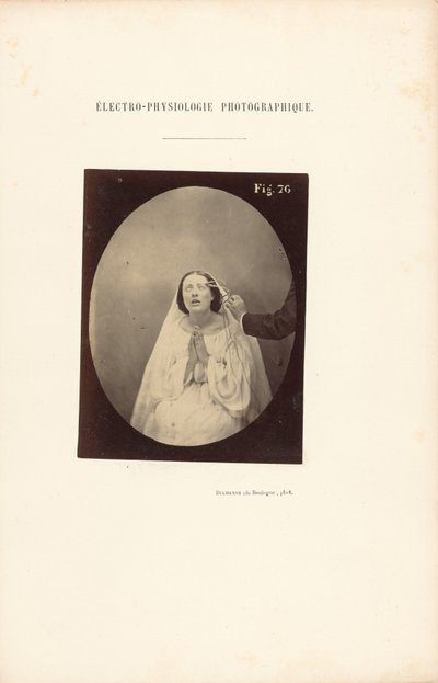 Elettrofisiologia fotografica, Figura 76 da Guillaume Benjamin Duchenne