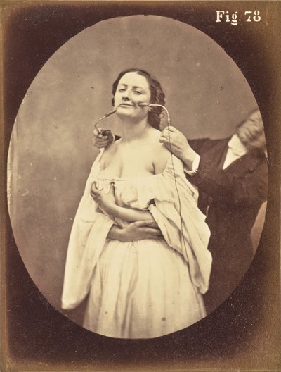 Fig. 78 da Guillaume Benjamin Duchenne