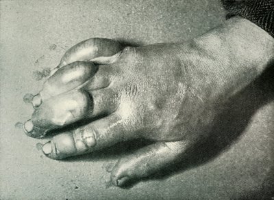 La mano congelata del Dr. Atkinson, 5 luglio 1911, 1913 da Herbert Ponting