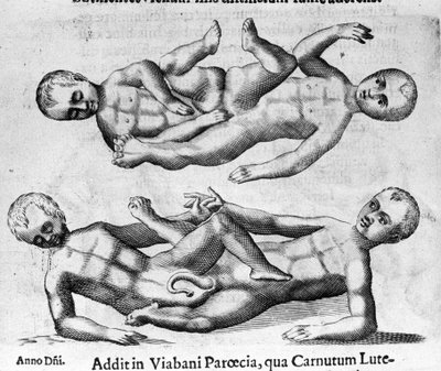 Diversi tipi di mostri umani: bambini siamesi collegati dal bacino. Incisione da “De monstrorum natura, causis et differentiis” di Fortunio Liceti (1577-1656), scienziato italiano. 1646 da Italian School