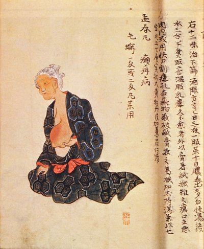 Il primo trattamento chirurgico del cancro al seno eseguito sotto anestesia generale da Seishu Hanaoka (1760-1836) nel 1804 da Japanese School