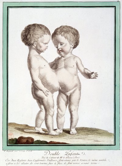 Bambini siamesi - in "Le deviazioni della natura" di Régnault da Jean Baptiste Regnault