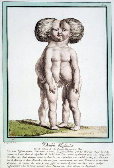 Bambini siamesi - in "Le deviazioni della natura" di Régnault da Jean Baptiste Regnault