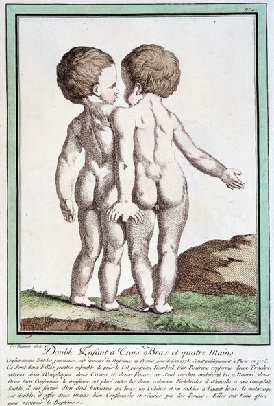 Bambini siamesi - in “Les deviations de la nature” di Régnault da Jean Baptiste Regnault