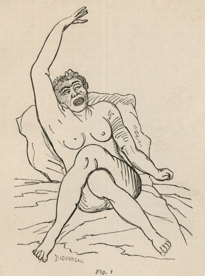 Epilepsia isterica, attacco, contorsioni, fig. 1 da 