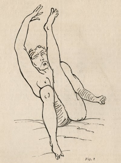 Epilepsia isterica, attacco, contorsioni, fig. 2 da 