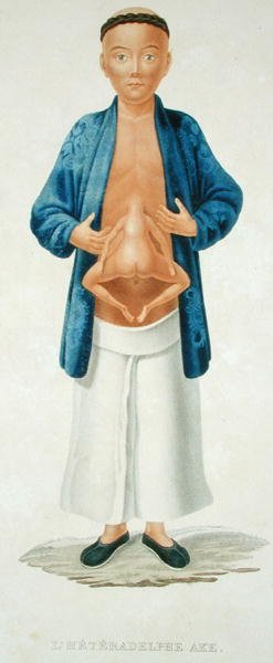 Uomo cinese con un gemello congiunto non sviluppato attaccato al suo addome, illustrazione da un libro di viaggi francese, inciso da M. Legrand da Jean Gabriel (after) Pretre