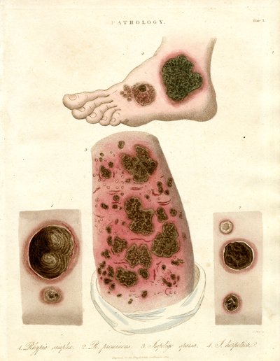 Condizioni cutanee patologiche - Pityria; Impetigine e Sifilide da John Pass