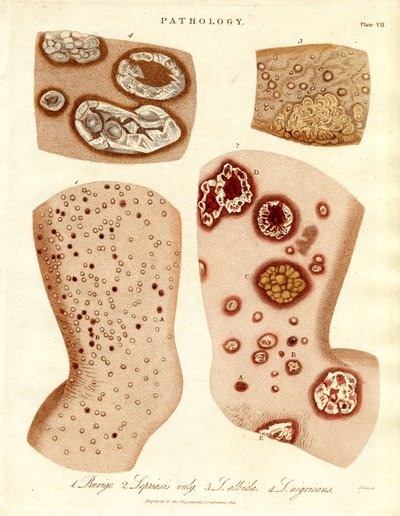 Condizioni patologiche della pelle: Schurigie; Pelle lebbrosa; Pallade e Impetigine da John Pass