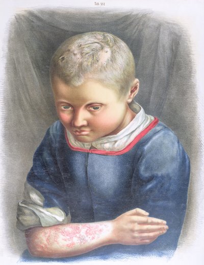 Favus, da un libro di Daniel Cornelius Danielssen (1815-94) 1892 da Norwegian School