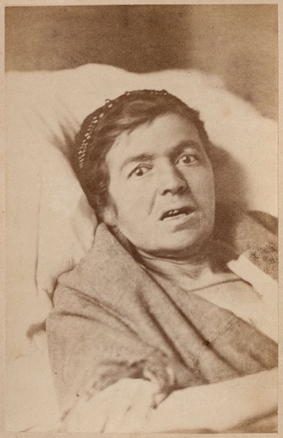 Epilepsia isterica, contrazione del viso, tavola VIII da 