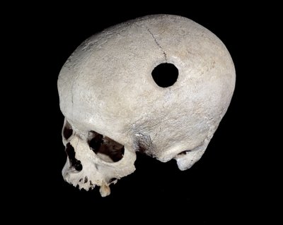 Teschio preistorico con traccia di trapanazione, Museo delle Antichità Nazionali da Prehistoric Prehistoric