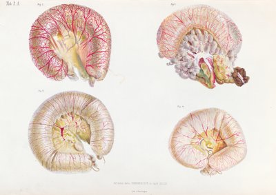 La superficie esterna degli intestini infettati dal colera, da Anatomie Pathologique du Cholera Morbus, di Nikolai Ivanovich Pirogov (1810-81) pubblicato a San Pietroburgo, 1849 da Russian School