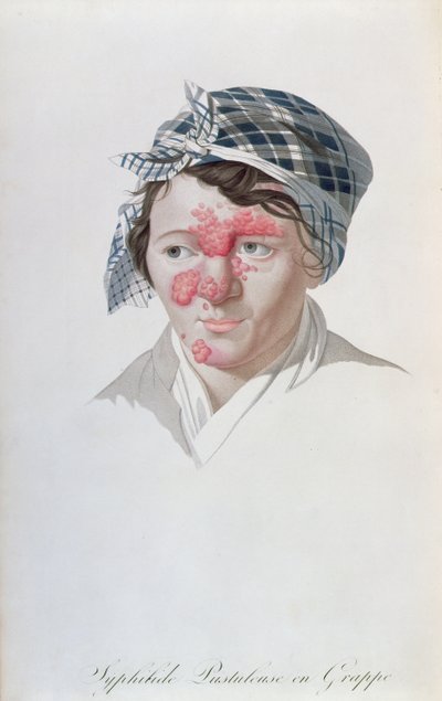 Pustole sifilitiche a grappolo, da un libro di Baron Jean Louis Alibert (1768-1837) 1838 da Salvadore Tresca