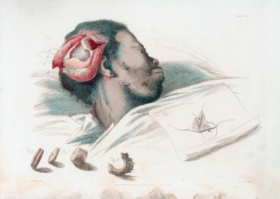 Vista della ferita nel cranio dopo trapanazione e rimozione del pezzo di osso frantumato in basso a sinistra, 1821 da Thomas Landseer