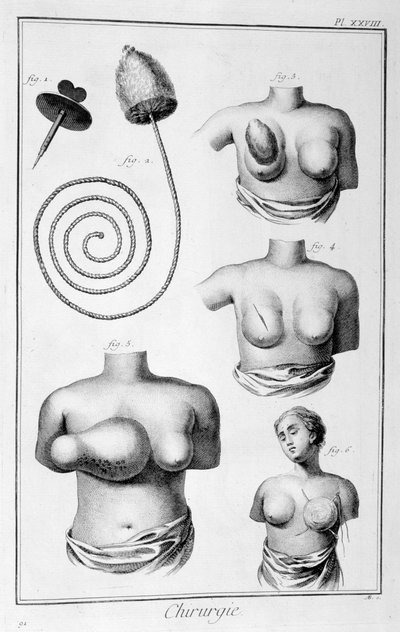Chirurgia del seno, 1751-1777 da Unbekannt